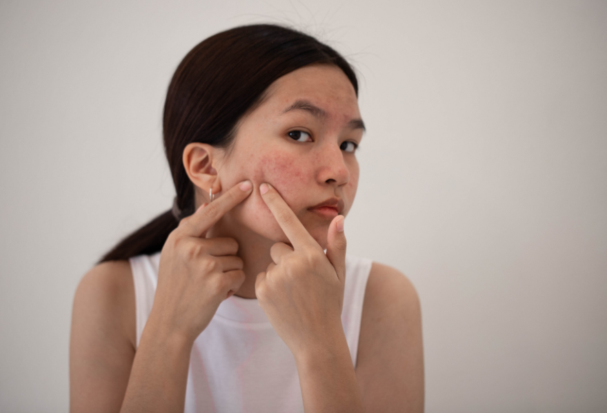 Bị mụn sau Tết, phải làm sao?