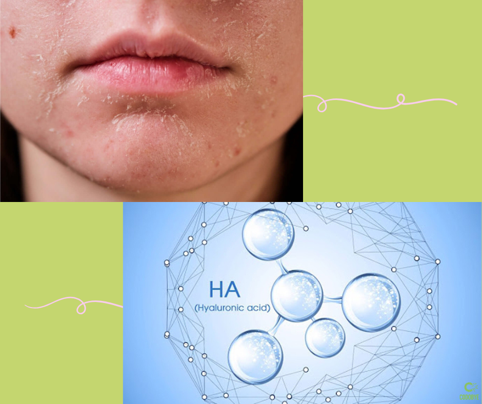 thiếu hụt hyaluronic axit khiến da bị khô