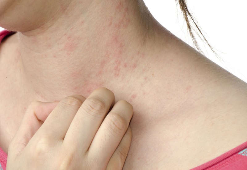 Căng thẳng khiến chúng ta rối loạn tự gãi nặn da