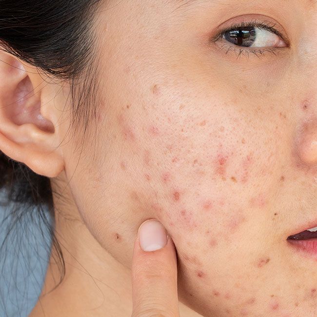 căng thẳng dẫn đến các vấn đề về da