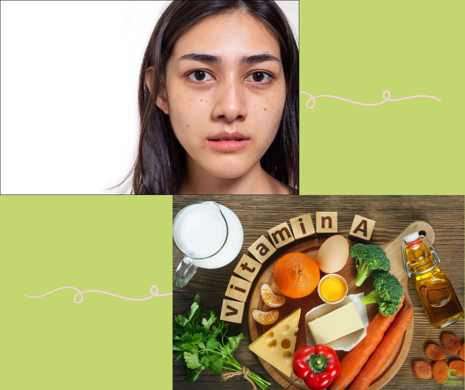 thiếu vitamin A gây tăng sắc tố da, da không đều màu