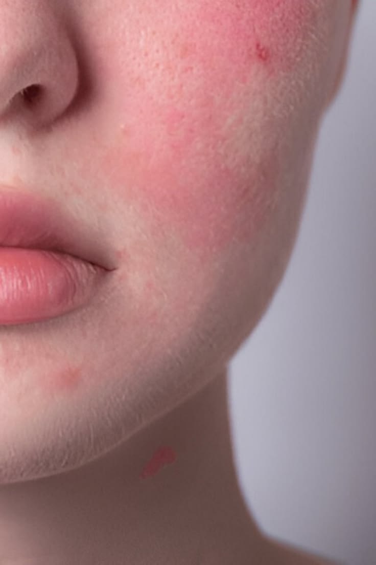Hàng rào bảo vệ da bị tổn thương khiến da dễ kích ứng và nổi mụn
