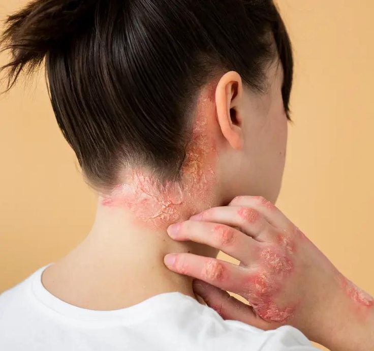 Ăn đường có nguy cơ tăng bệnh vẩy nến