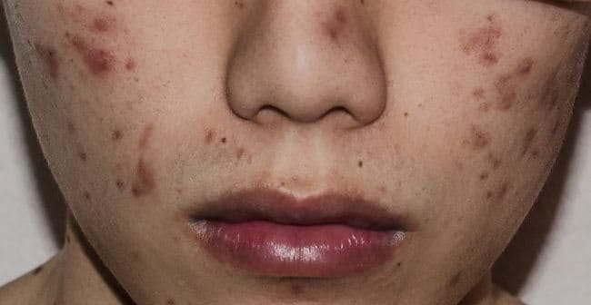 Cơ chế tăng sắc tố sau viêm (PIH) do mụn viêm kích thích melanocyte sản xuất melanin