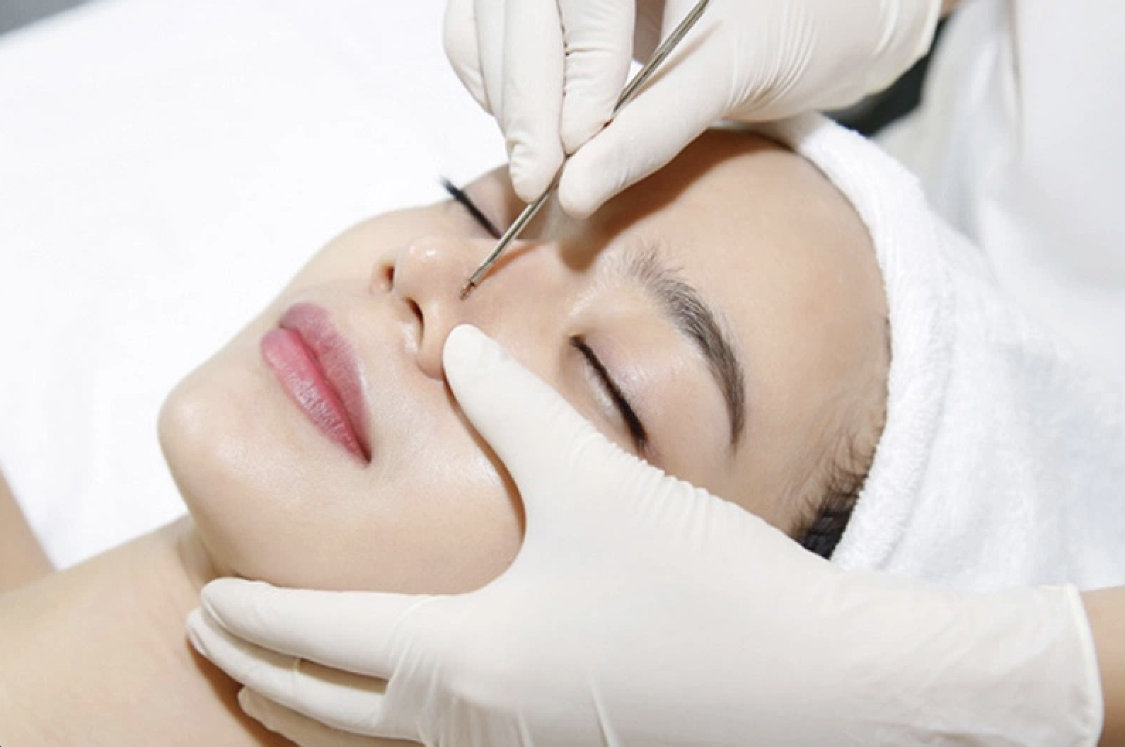 Cần kiêng một số thực phẩm sau nặn mụn