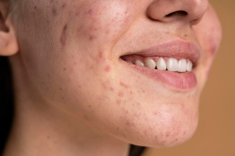 Mụn đã giảm nhưng da vẫn sần, xỉn màu và chưa đều màu như mong muốn