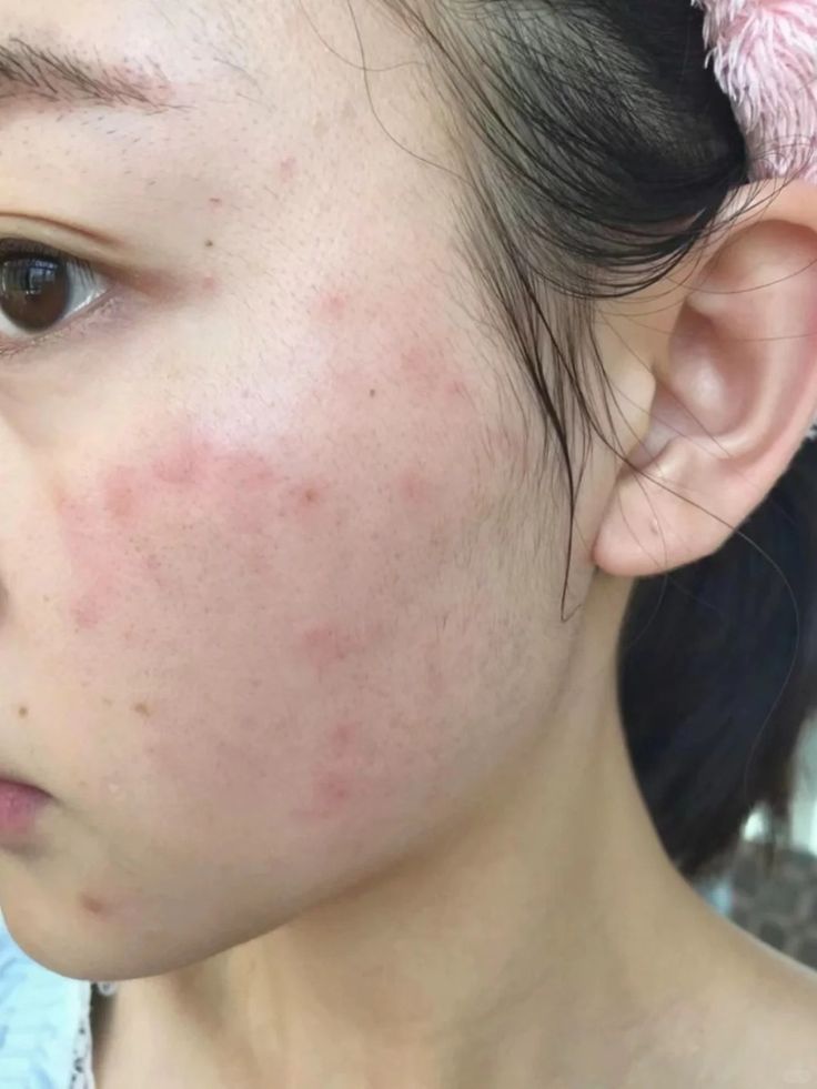 Mụn ở Gen Z là vấn đề thường gặp và có thể cải thiện khi chăm da đúng cách