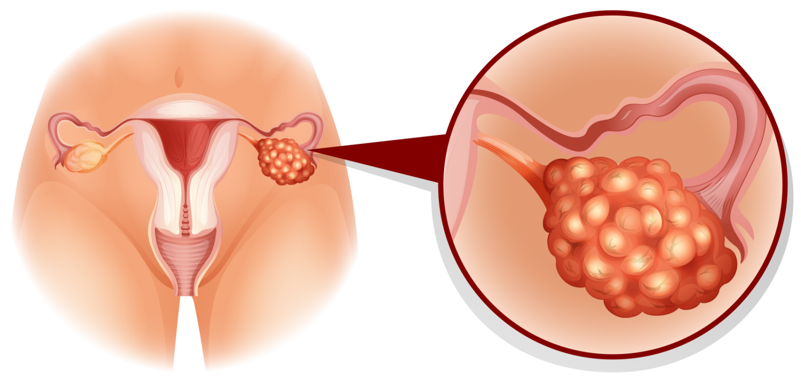 PCOS có thể gây rối loạn nội tiết, làm xuất hiện mụn trứng cá dai dẳng
