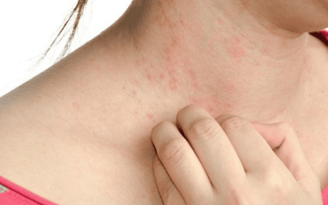 da phát ban là bị bệnh gì