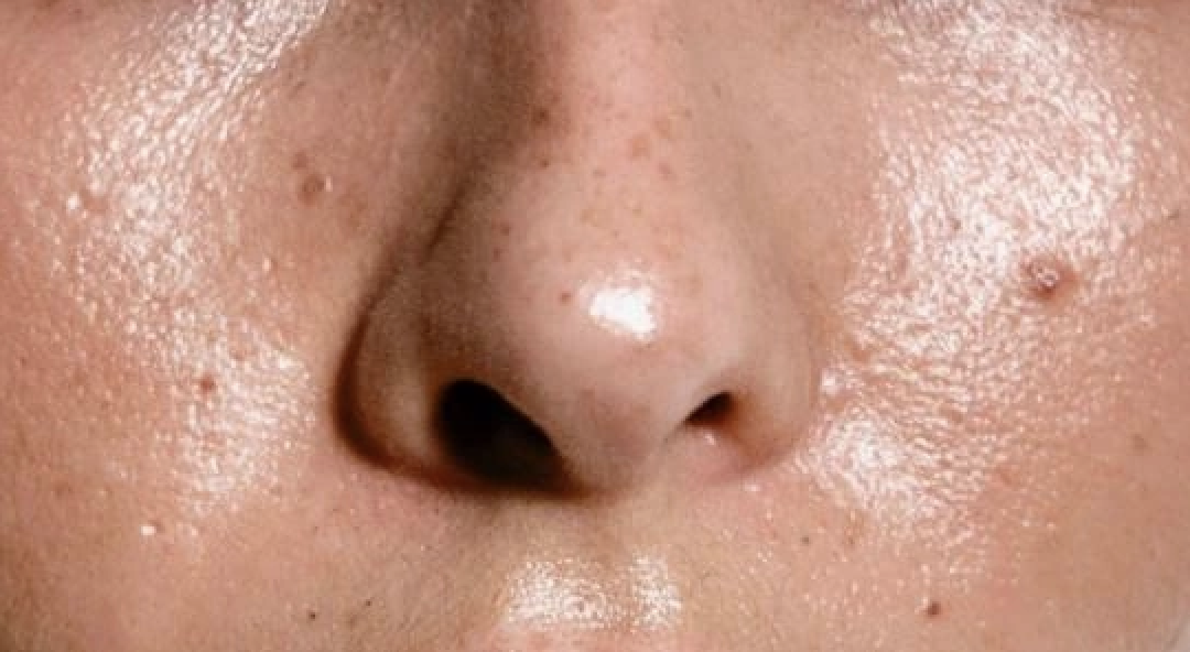 Tuyến bã nhờn hoạt động mạnh ở da dầu làm tăng nguy cơ mụn viêm và thâm mụn