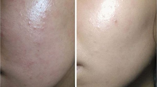 Bí quyết trị mụn ẩn và dưỡng sáng da của mình
