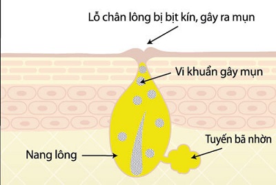 Bộ sản phẩm trị mụn CODOBYE ức chế hoạt động của tuyến nhờn