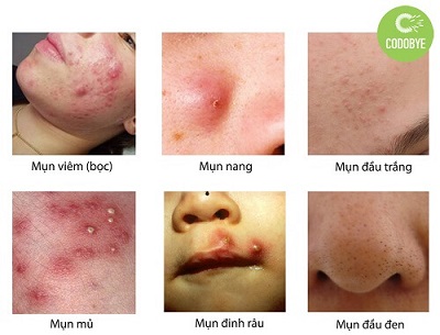 Các dạng mụn phổ biến