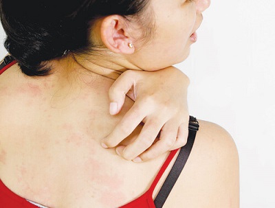 Cách trị mụn trứng cá ở lưng?