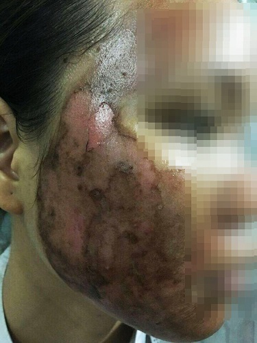 Cảnh báo nguy cơ bỏng mặt vì sử dụng rượu thuốc để trị mụn