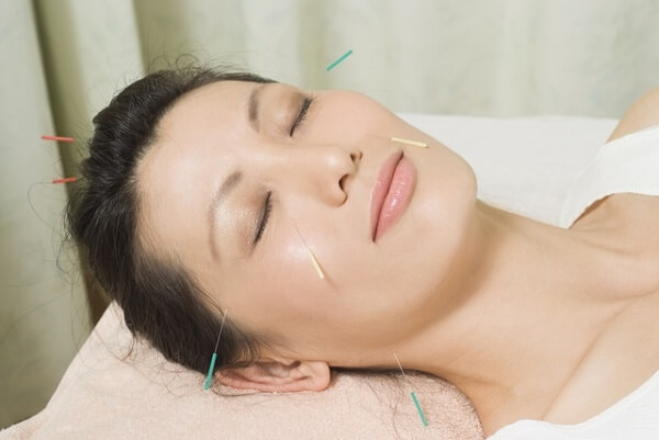 Châm cứu có thể giải quyết gốc rễ mụn trứng cá