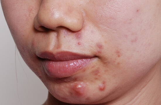 Chia sẻ bí quyết trị mụn bọc hiệu quả của mình