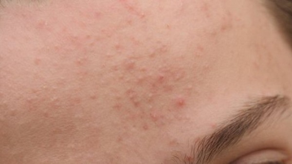 Cơ chế trị mụn của viên uống là đẩy mụn lên trên