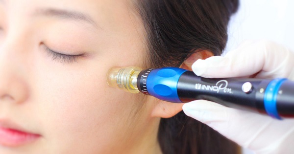 Có nên đi lăn kim để trị mụn không?