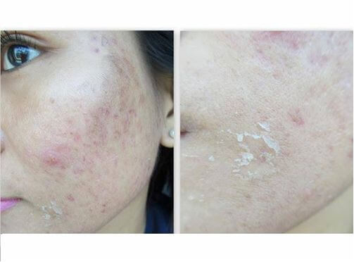 Có phải ai cũng được phép peel da hay không?