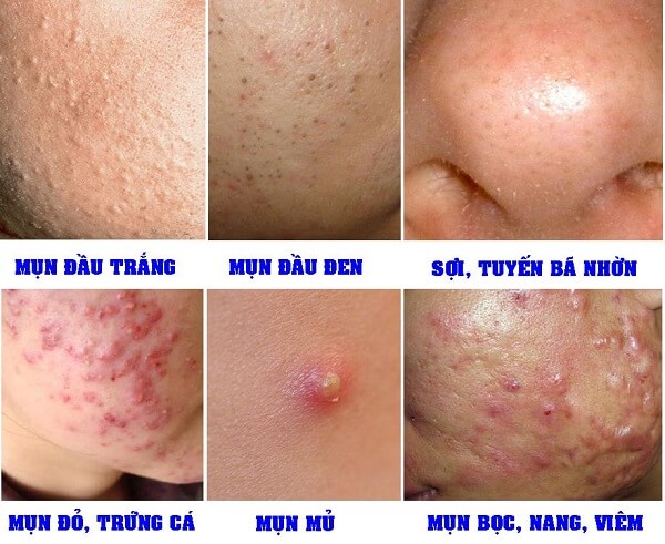 Có rất nhiều loại mụn trứng cá khác nhau