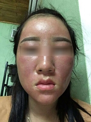 Da mình bị nhiễm Corticoid nặng nề