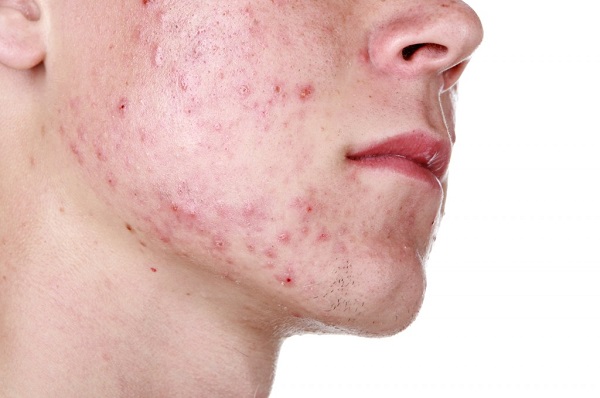 Da mình trước đây bị mụn và nhờn rất nhiều