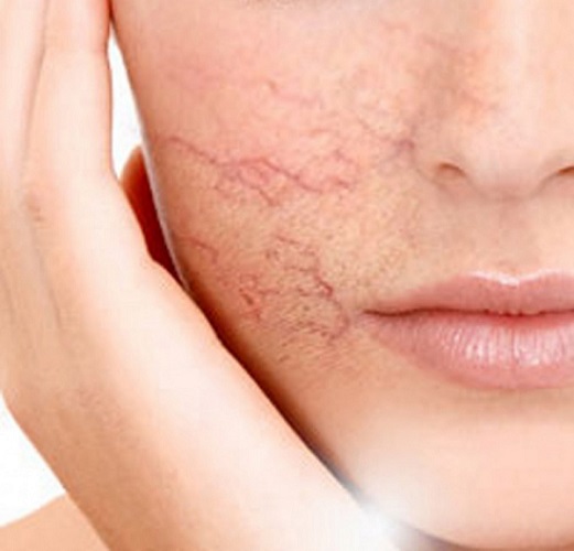 Da mỏng đi do sử dụng sản phẩm trị mụn không rõ nguồn gốc