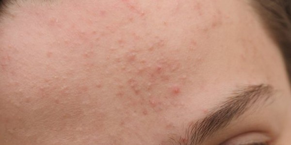 Dấu hiệu nhận biết mụn ẩn