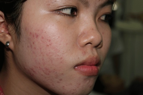 Đeo khẩu trang kín bí tách cả ngày gây ra mụn trứng cá