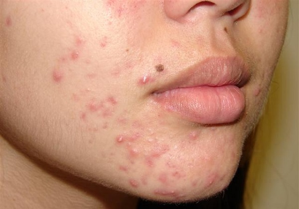 Gan nhiễm độc gây mụn ẩn dưới da