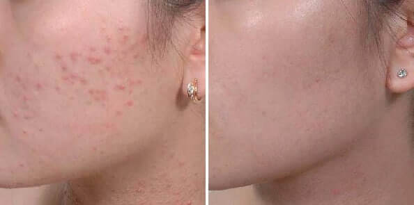 Hiểu đúng về mụn ẩn dưới da để trị mụn đúng cách