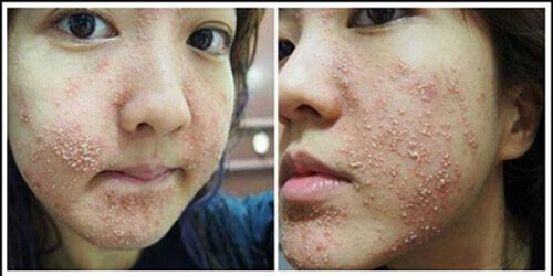 Kem tắm trắng có thể chứa các chất hóa học gây hại cho da