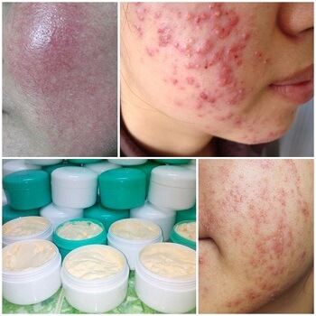Không nên tự ý trị mụn bằng các sản phẩm trôi nổi