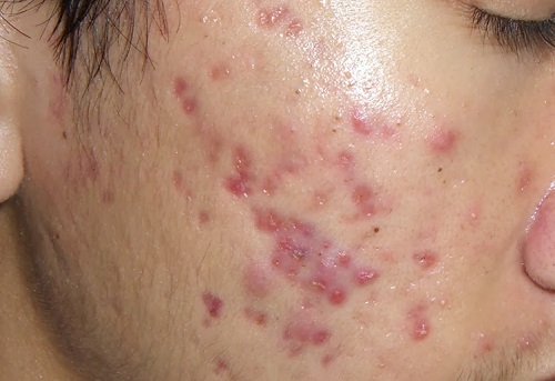 Làm sao để trị mụn trứng cá do di truyền