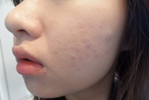 Làn da không được làm sạch đúng cách gây mụn ẩn