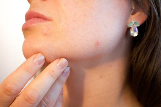 Làn da nhạy cảm rất dễ nổi mụn và bị kích ứng