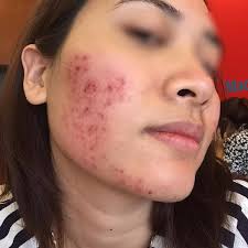 Lăn kim có thể dẫn đến nguy cơ lây lan mụn