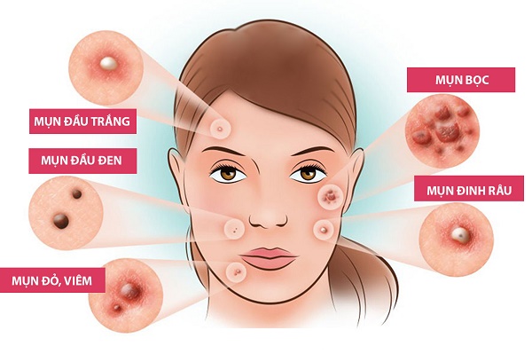 Phong nhiệt kết tụ ở phế được đưa đến bì phu tấu lý mà không truyền tống ra ngoài được lưu chú lâu ngày thành những mụn ung