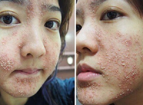 Mặt nổi mẩn ngứa, đỏ tấy, rát da, thậm chí phồng rộp, mụn mủ