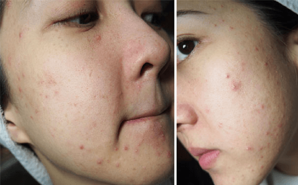 Mụn ẩn là gì? Cách ngăn ngừa mụn ẩn hiệu quả