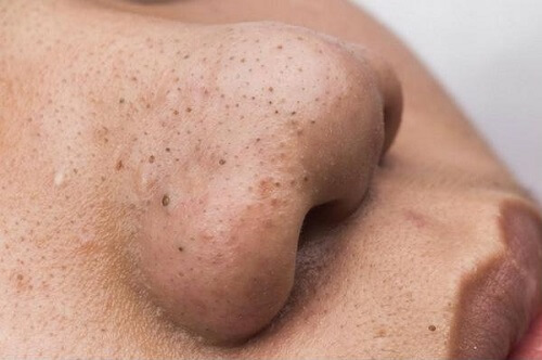 Mụn đầu đen chủ yếu tập trung ở vùng mũi