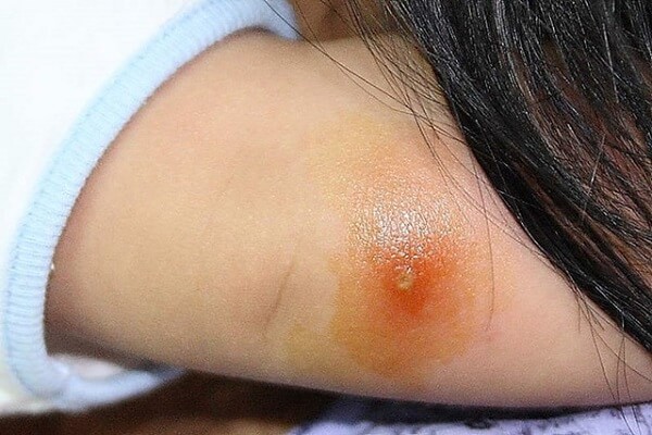 Mụn đinh râu rất độc, thường xuất hiện ở vùng miệng