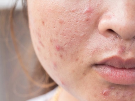 Mụn là một loại bệnh về da thường gặp