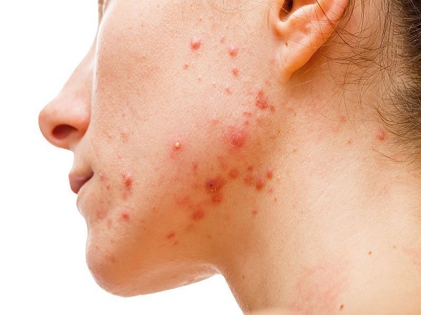 Mụn trứng cá kẻ thù truyền kiếp của làn da