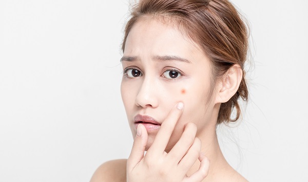 Mụn trứng cá và những điều chưa biết
