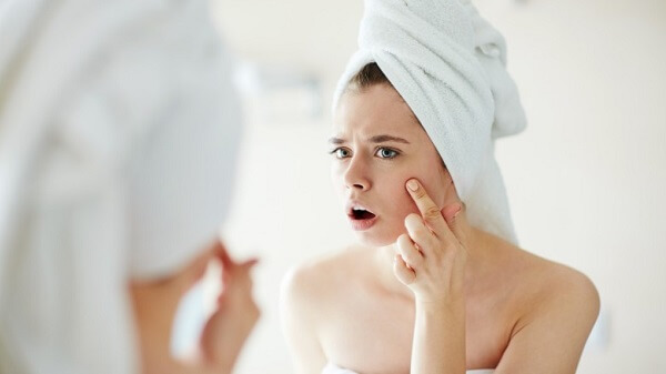 Mụn trứng cá vấn đề nan giải của thanh thiếu niên hiện nay