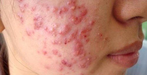 Mụn và những phương pháp trị mụn hiệu quả, có thể bạn chưa biết?