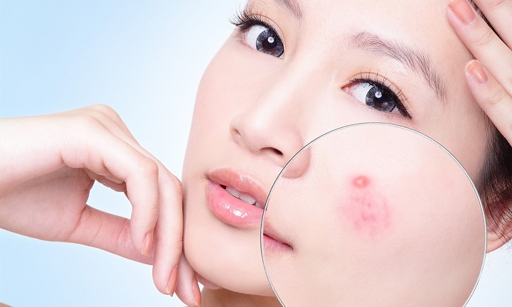 Nên điều trị mụn từ sâu bên trong