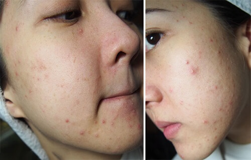 Ngưng dần tần suất khi da đã hết mụn